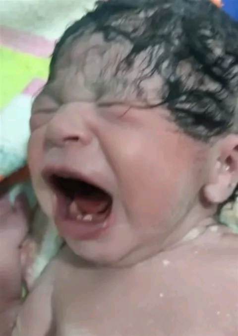 "حالة نادرة" ولادة طفلة بـ"سنتين"