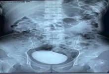 Photo of بالصور… طبيب يخرج شيئًا طوله « 10 سم» من مثانة امرأة