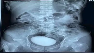 Photo of بالصور… طبيب يخرج شيئًا طوله « 10 سم» من مثانة امرأة
