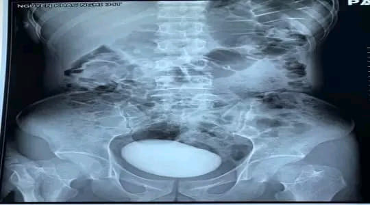 بالصور... طبيب يخرج شيئًا طوله « 10 سم» من مثانة امرأة