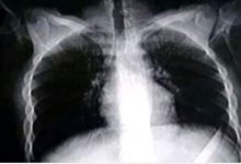 Photo of الفريق الطبي بمستشفى المنصورة ينجح في إستخراج سكينه طولها 27 سنتيمتر من معدة شاب
