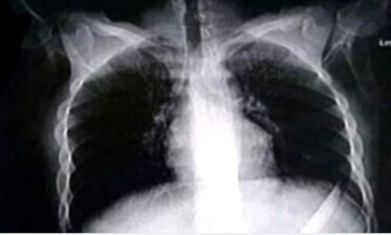 Photo of الفريق الطبي بمستشفى المنصورة ينجح في إستخراج سكينه طولها 27 سنتيمتر من معدة شاب