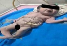 Photo of عجائب الجنوب ولادة نادرة و غربية لطفل بدون بطن في الأقصر