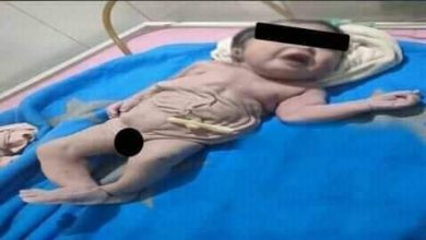 Photo of عجائب الجنوب ولادة نادرة و غربية لطفل بدون بطن في الأقصر