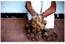 Photo of “رجل” يتحول أطرافه الي جذوع شجر… تعرف علي رجل الشجرة