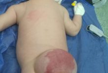 Photo of إستئصال ورم وكيس بالظهر لطفل حديث الولاده بمستشفى أطفال بنها