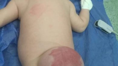 Photo of إستئصال ورم وكيس بالظهر لطفل حديث الولاده بمستشفى أطفال بنها