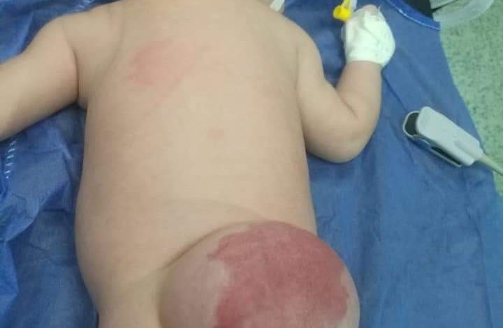 Photo of إستئصال ورم وكيس بالظهر لطفل حديث الولاده بمستشفى أطفال بنها
