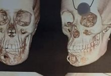 Photo of استئصال كيس من عظام الفك السفلي لفتاة بمستشفى جامعة بنها