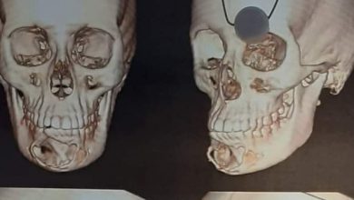 Photo of استئصال كيس من عظام الفك السفلي لفتاة بمستشفى جامعة بنها