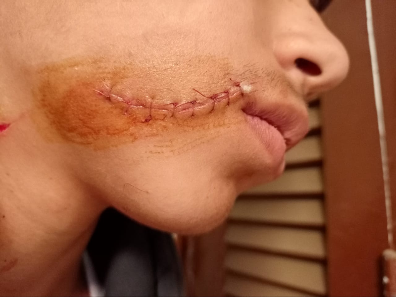 شهدت قرية كفر طحا التابعة لمركز شبين القناطر بمحافظة القليوبية واقعة مؤسفة . حيث اعتدى طالب بمعهد الاعدادية الازهري بكفر طحا بشبين القناطر على زميله بعد نهاية الامتحانات بسلاح أبيض كتر بسبب مشاجرة بينهما بعد انتهاء الامتحانات بسبب رفضه تغشيشه في الامتحان تلقي اللواء مدير أمن القليوبية إخطارا بتلقي مركز شرطة شبين القناطر بلاغا من والد أنس مرسي عبدالعظيم بالصف الثالث الإعدادي ازهري والمقيم بكفر طحا مركز شبين القناطر بقيام زميله م ط ا والمقيم بقريةالقشيش بتعديه بالضرب بأله حادة - كتر - وإصابته بإصابات في وجهه . تم تحرير محضر بالواقعة حمل رقم ٣ إداري مركز شرطة شبين القناطر وإحالته للنيابة التى تولت التحقيق. من جانبه ناشد والد الطالب المصاب بتدخل عاجل من شيخ الأزهر ومدير المنطقة الأزهرية بالقليوبية واتخاذ الإجراءات القانونية حيال الواقعة منعا لتكرارها