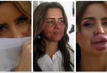 Photo of أخصائي تجميل يتسبب في تشويه وجه الفنانة اللبنانية نور.. صور