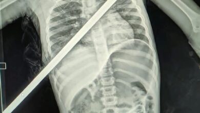 Photo of مستشفى بنها الجامعي تنقذ طفلة من الموت بعد اختراق سيخ حديدي لصدرها في عملية دقيقة استمرت 3 ساعات